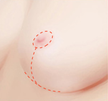유륜주위 가슴축소수술